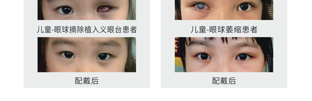 兒童定做義眼片